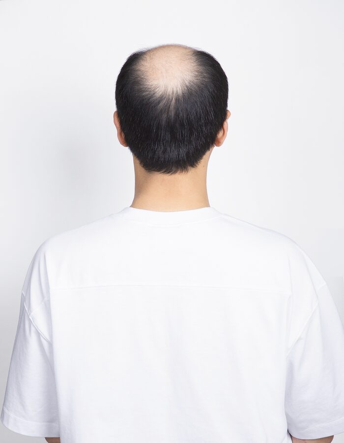 탈모 정수리